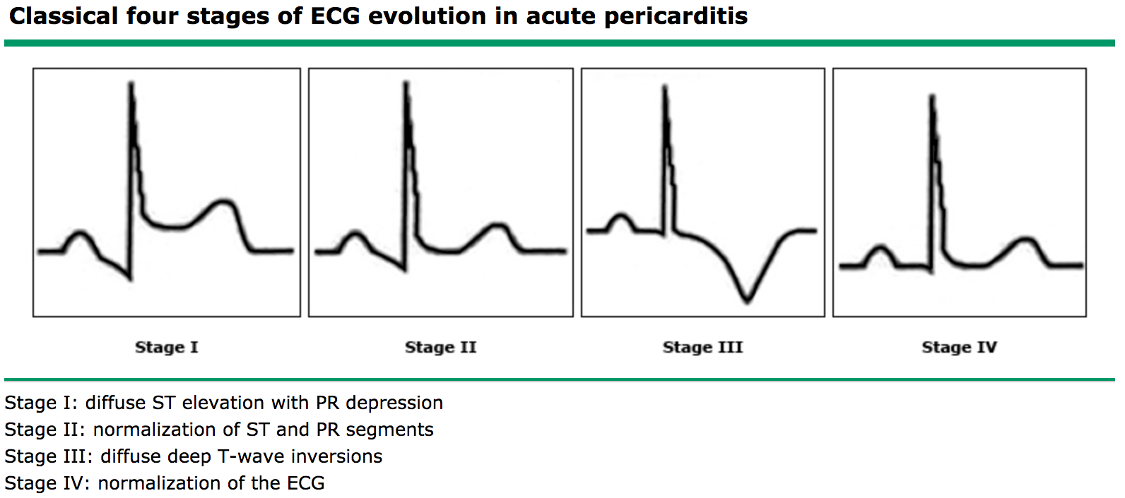 EKG Changes in Pericarditis